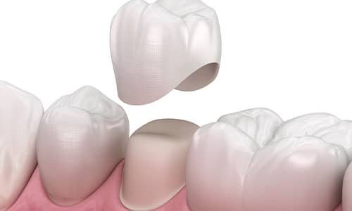 Dental Crowns