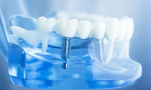 Dental Implants