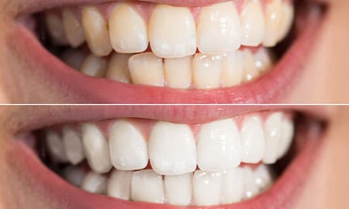 before and after teeth whitening