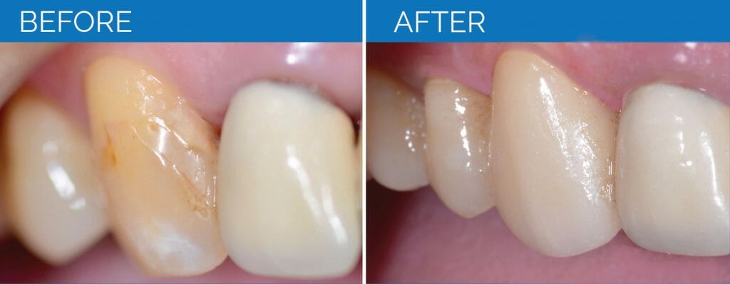 Tooth Before and After Photos