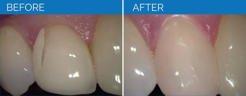 Before and After Teeth