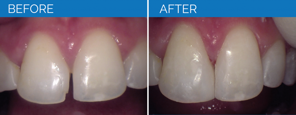 Before and After Restorative Dentistry
